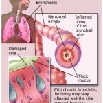 bronchitis_basics