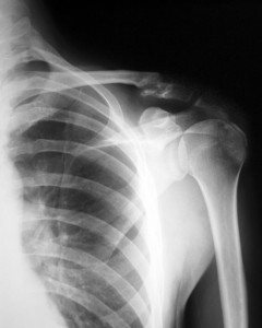 Top 10 Tips for Surviving a Shoulder Fracture | OsteoDiet.com