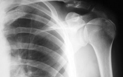 Top 10 Tips for Surviving a Shoulder Fracture